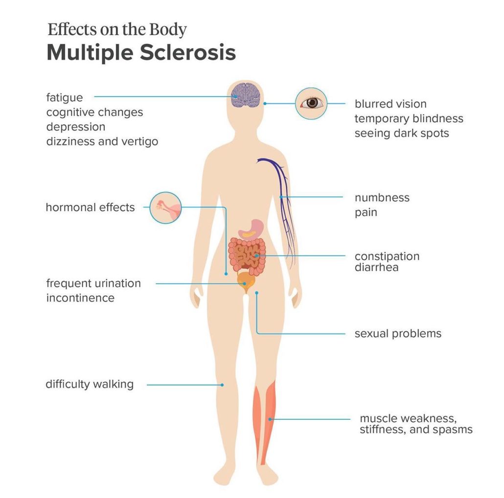 15 Signs And Symptoms Of Ms In Women Morelia Medical Clinic