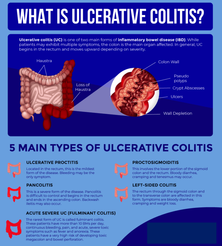 Ulcerative colitis is a relatively common longterm condition that